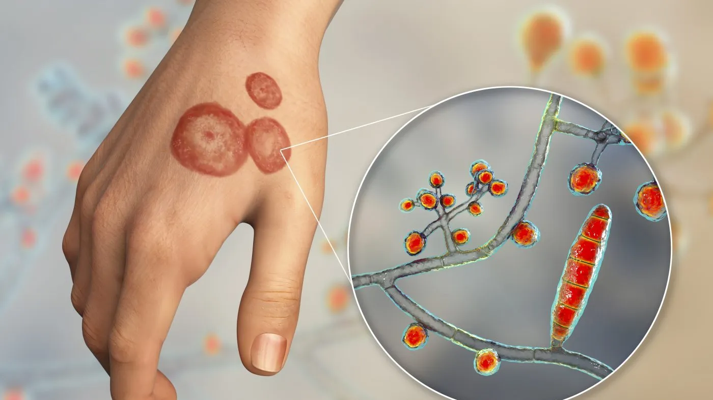 Fungal infection on a man’s hand, illustration. Known as ringworm infection, or tinea manuum. It can be caused by various fungi, including Trichophyton mentagrophytes. It causes severe itching. The disease is highly contagious, and can be spread by direct contact or by contact with contaminated material. Treatment is with antifungal drugs