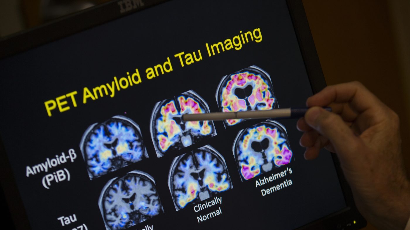FILE – R. Scott Turner, Professor of Neurology and Director of the Memory Disorder Center at Georgetown University Hospital, points to PET scan results that are part of a study on Alzheimer’s disease at Georgetown University Hospital in Washington, May 19, 2015. (AP Photo/Evan Vucci, File)