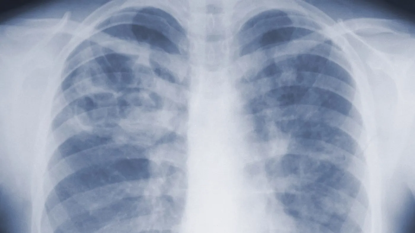 A chest x-ray provided by the U.S. Centers for Disease Control and Prevention. (CDC via AP)