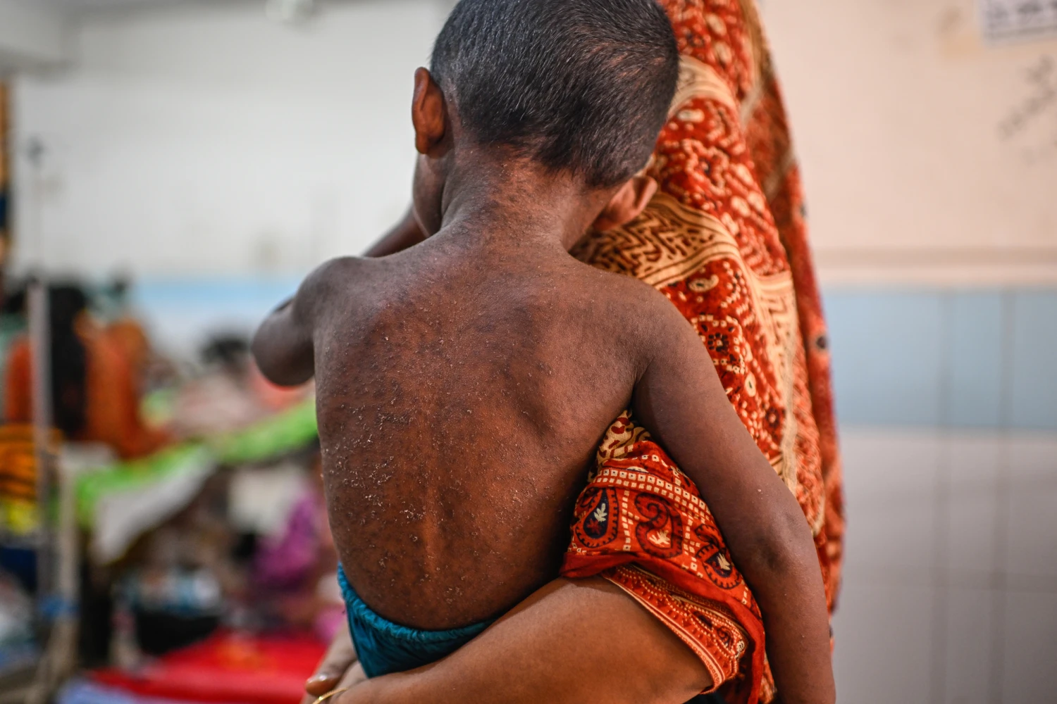 A woman brings her child for treatment of measles during the outbreak, in a hospital in Dhaka, Bangladesh, Tuesday, Sept. 8, 2026.