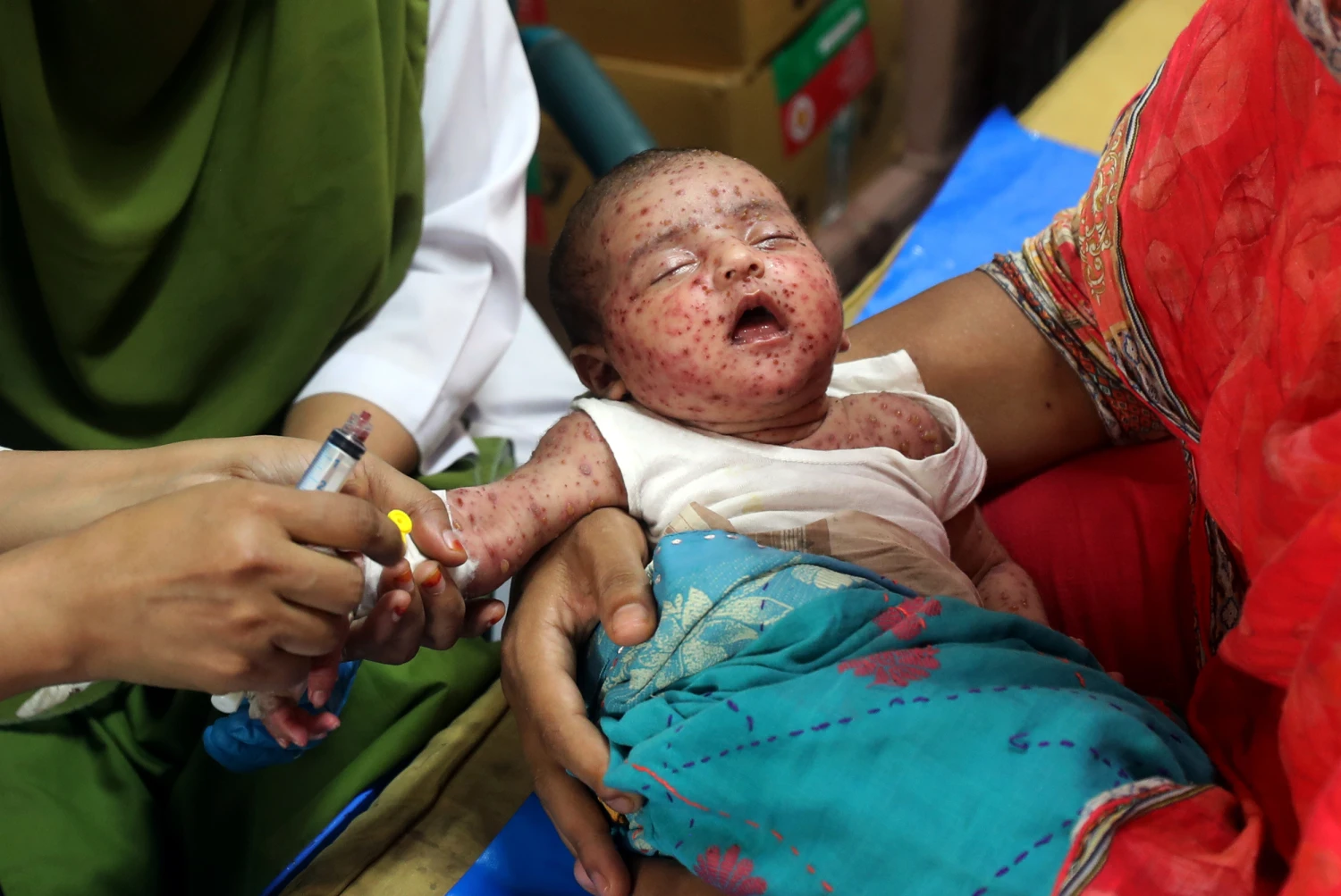 Children infected with measles receive treatment at the Infectious Disease Hospital in Dhaka, Bangladesh, on April 6, 2026.